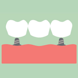 dental-bridge-illustration-sq-300