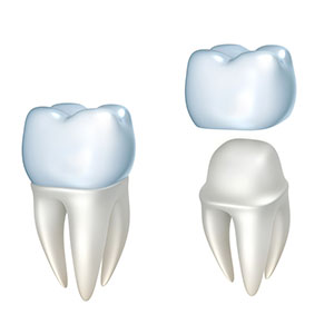 dental-crown-illustration-sq-300