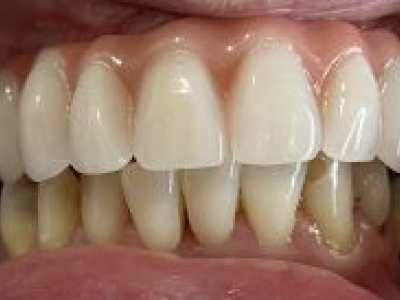 Smiling patient promotional frame or testimonial layout