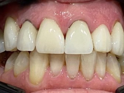 Frame design showing cosmetic dentistry transformation result