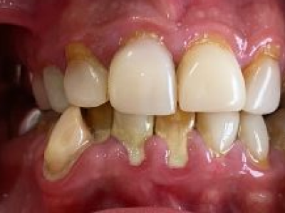 Comparison of teeth alignment before and after dental treatment