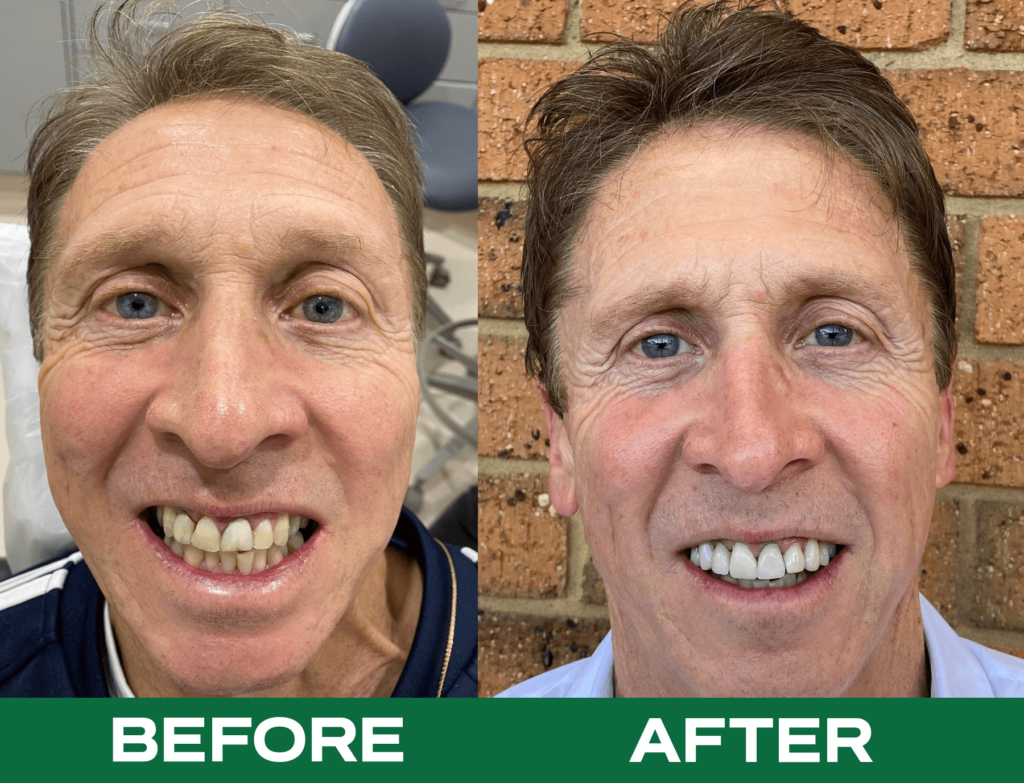 Before-and-after image highlighting veneer dental treatment