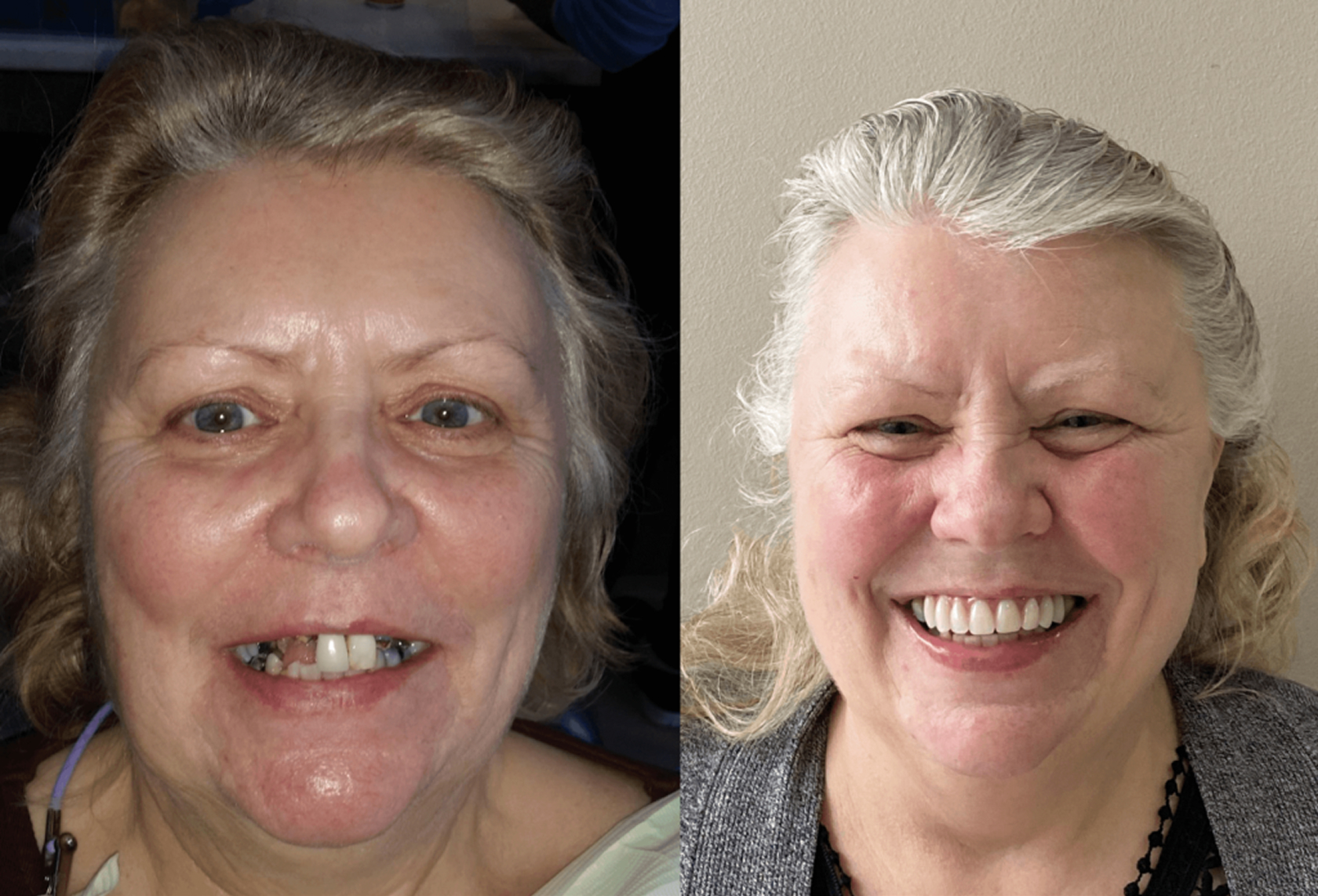 Meg – All on 4 Dental Implants Treatment