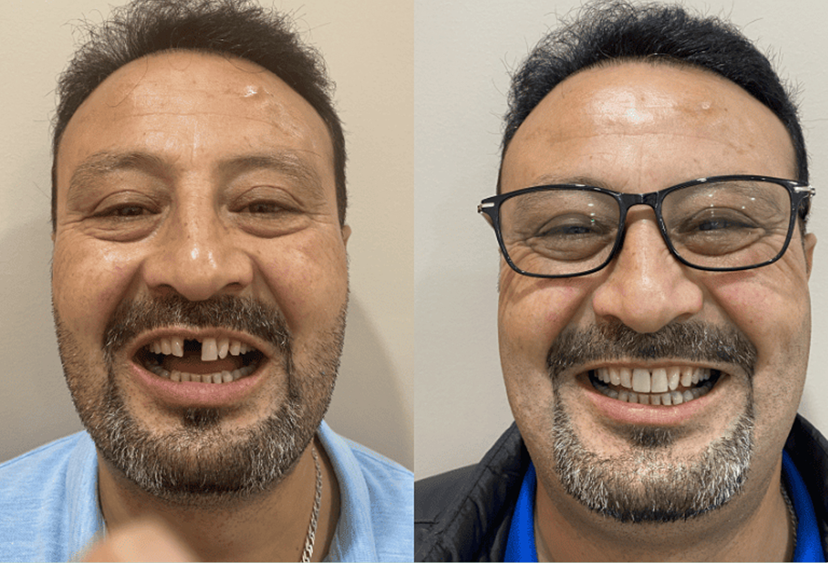Implant - Front Tooth replacement
