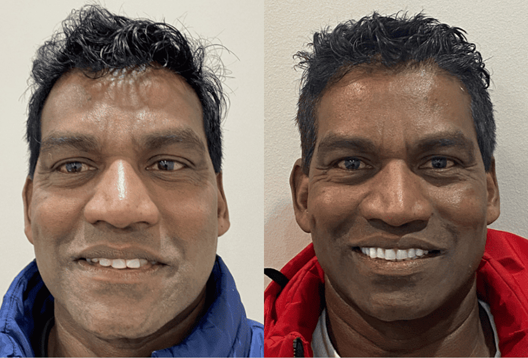 Ramdoo–All ON 4 Treatment