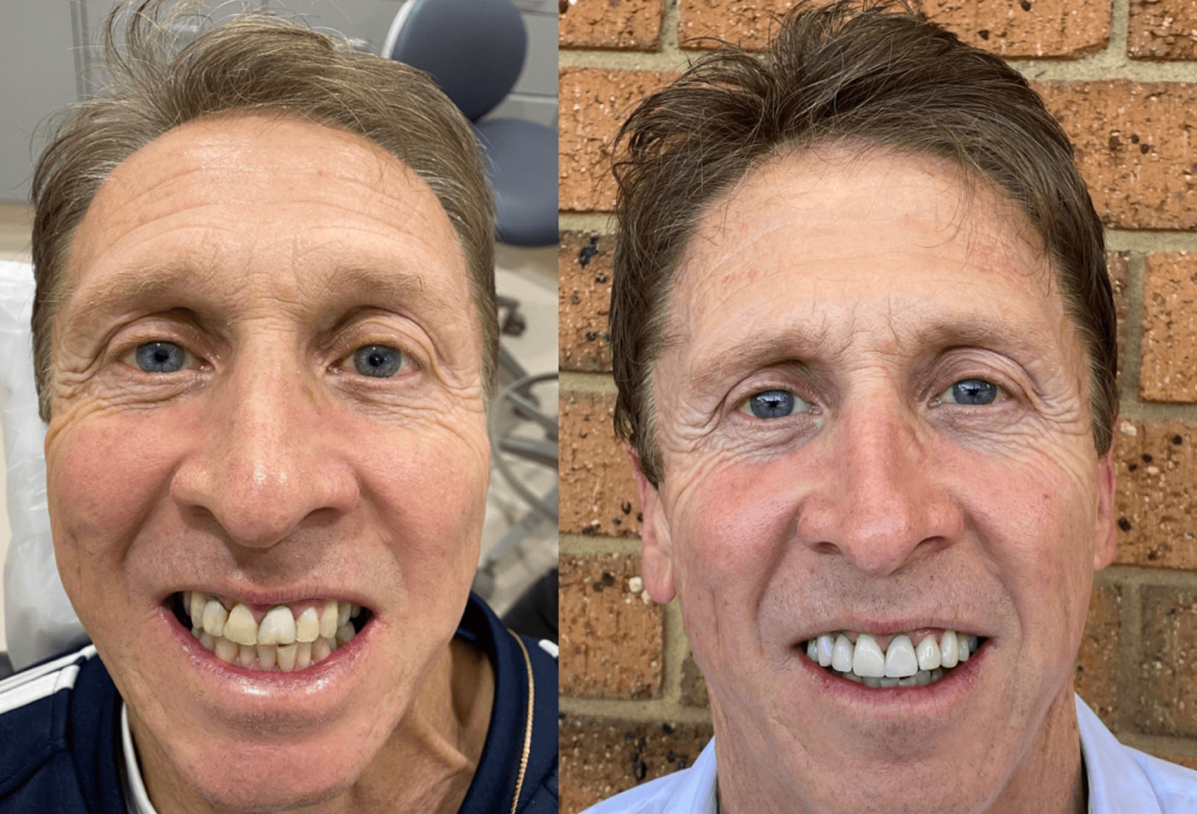 Vin – Porcelain Veneers