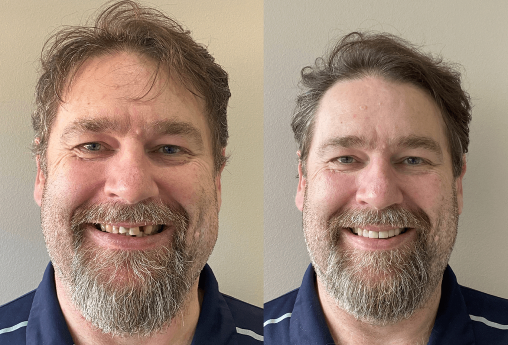 Dan – Porcelain Veneers