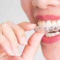 The Science of a Straighter Smile: How Invisalign Technology Works Beyond Basic Aligners