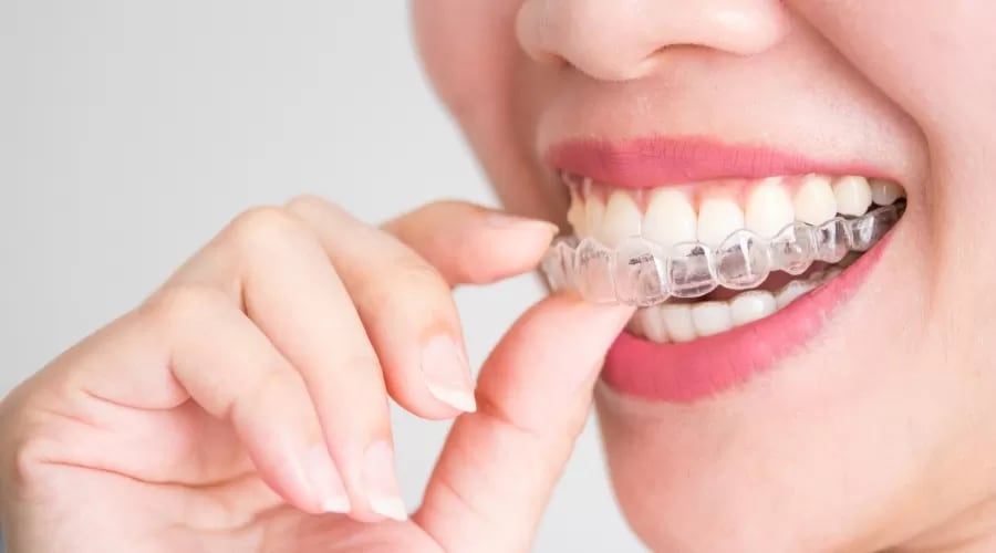 Invisalign clear aligners for comfortable teeth straightening