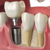 Dental Implants-2
